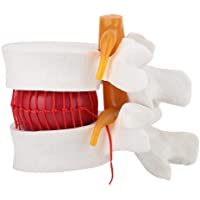 Los mejores  - Anatomía humana- 1: 1.5 Modelo de demostración de hernia de disco lumbar humano del modelo de columna vertebral lumbar…